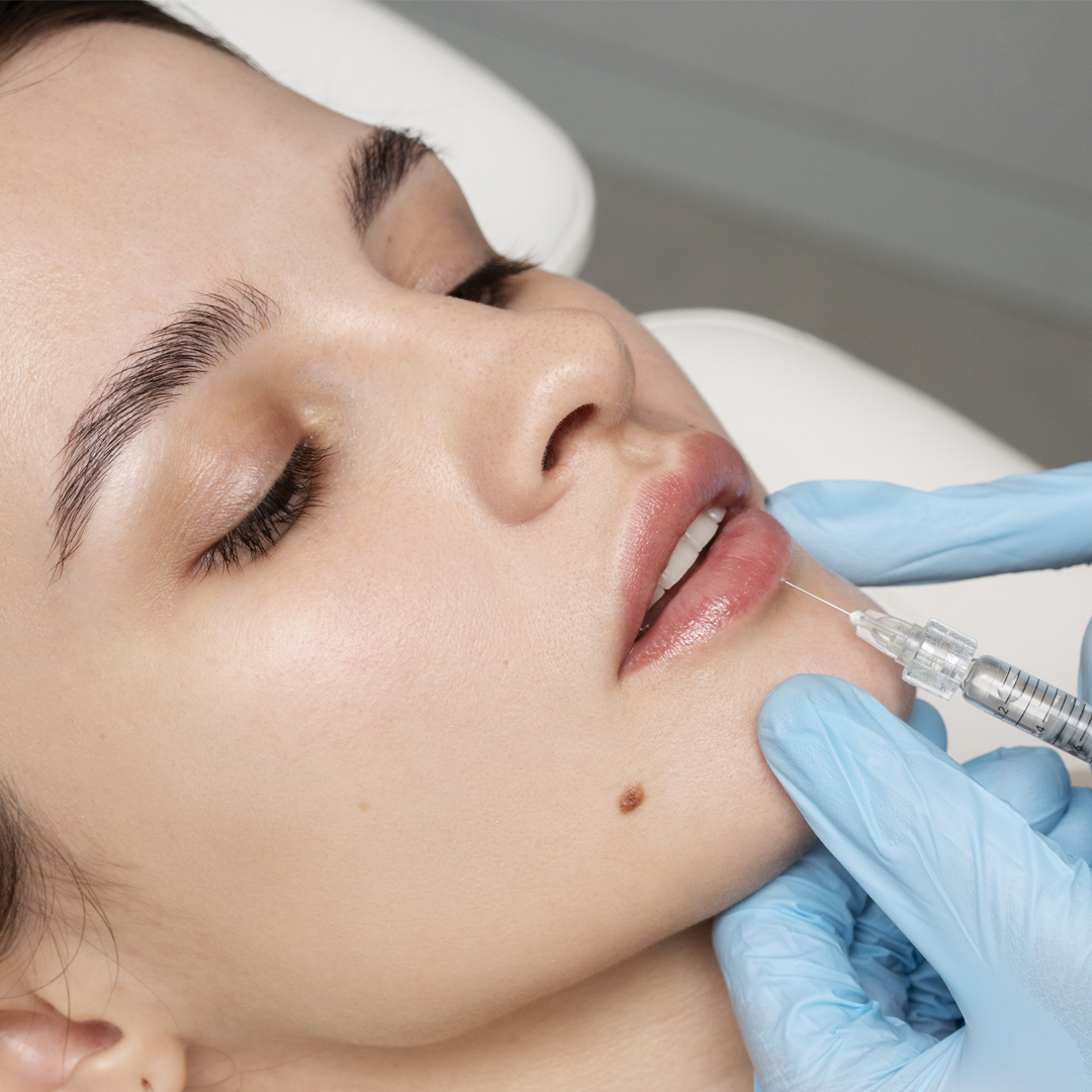 Lip Fillers Image