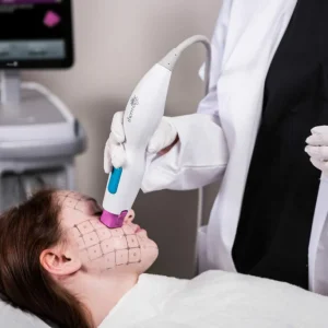 Thermage treatment
