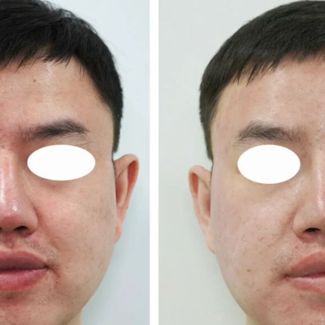 before and after of a mans skin health before exosomes micrnedling and after exosomes microneedling